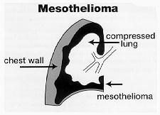 Graphic - Asbestos Disease